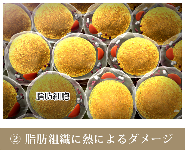 ハイフエステの詳細