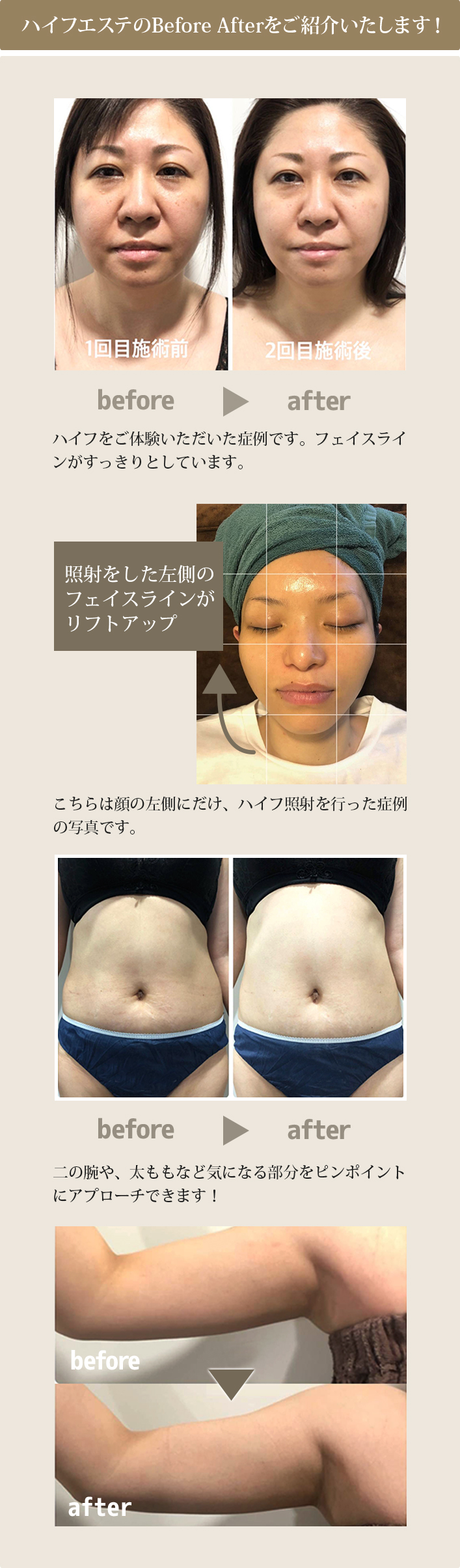 ハイフエステの効果