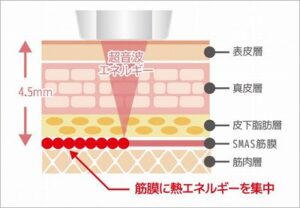 無痛ハイフエステ