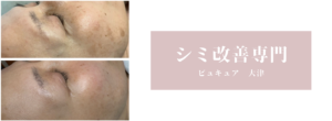 シミ(しみ)改善　シミ(しみ)にお困りの方　