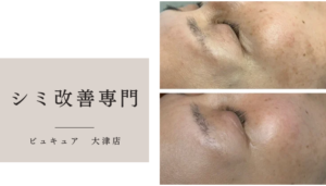 シミ(しみ)改善　シミ(しみ)でお困りの方は　シミ(しみ)改善エステがオススメ