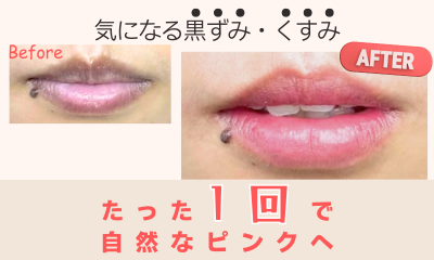 黒ずみケア