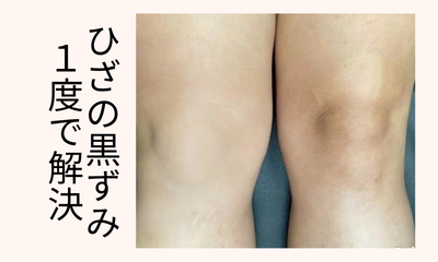 メラニンケアひざ
