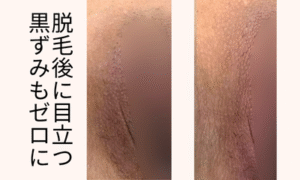 メラニンケアＩライン