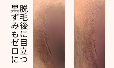 メラニンケアＩライン